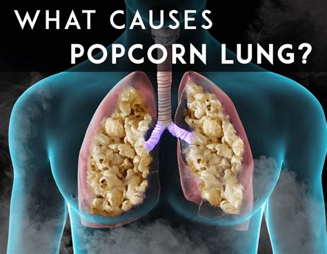 What is popcorn lung? Can you get it from vaping? – Ruthless Vapor ...