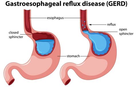 What are the Clinical Features and Treatments for Hiatus Hernia ...