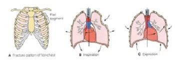 Flail Chest: Symptoms & Treatment | Study.com