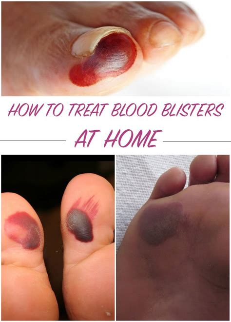 How to Treat Blood Blisters at Home - Everything in one place