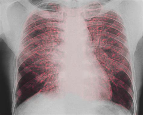 Pulmonary Sarcoidosis: Independent Predictors of Mortality ...