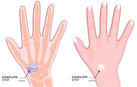 Ganglion Cyst of the Wrist: How Do I Know if I Have One?