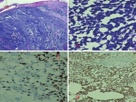 Histopathological images from the inguinal lymph nodes biopsy. (A,B)... | Download Scientific ...