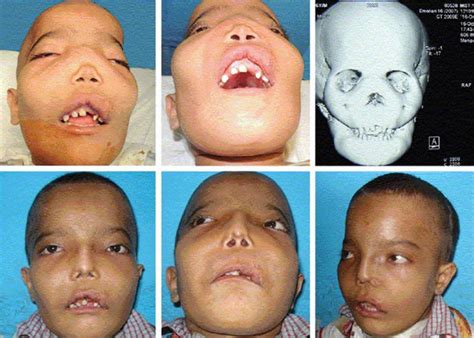 Fibrous dysplasia causes, symptoms, diagnosis, treatment & life expectancy