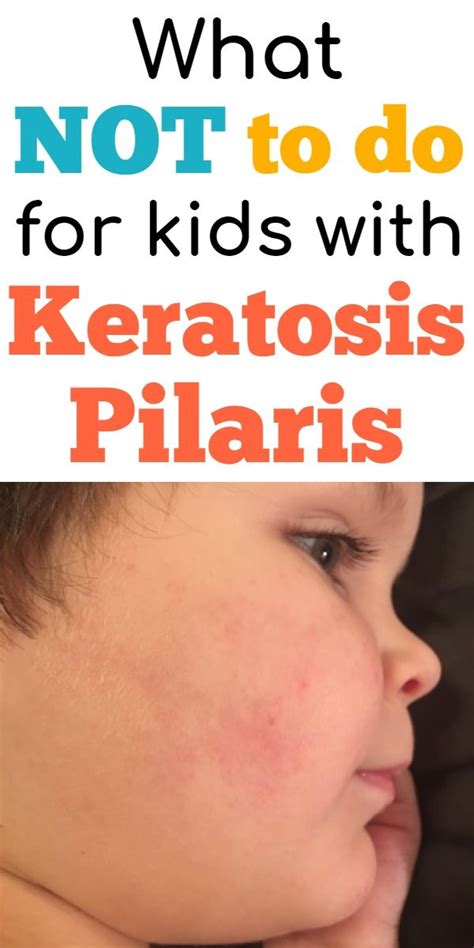 Keratosis Pilaris Treatment: What NOT to do for KP skin. | Kids dry skin, Keratosis pilaris ...