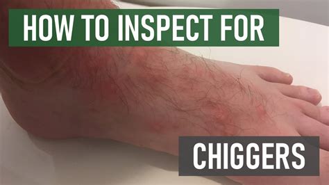 How To Get Rid Of Chiggers On Your Dog