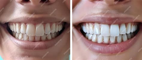 Premium Photo | Before and after photo of a womans teeth postwhitening ...