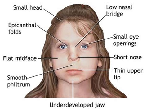 Fetal Alcohol Syndrome - Signs & Symptoms, In Baby, Adults & Treatment