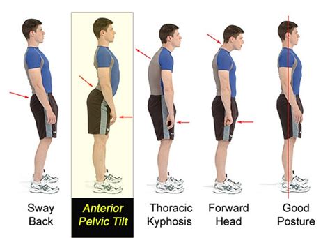 What is a Pelvic Tilt? - Body Focus Physiotherapy