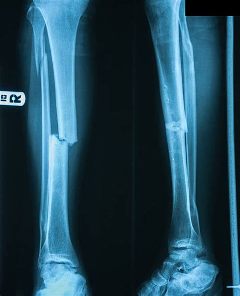 Fractured Fibula Stock Photos, Pictures & Royalty-Free Images - iStock