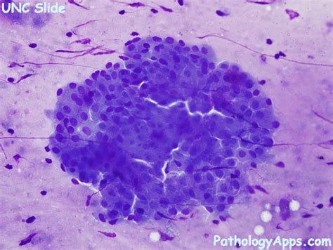 warthin tumor salivary gland cytology