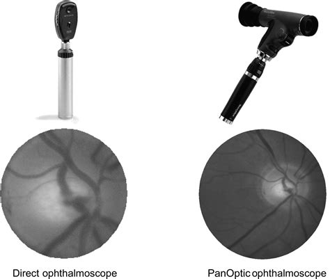 Optic disc assessment in the emergency department: a comparative study ...