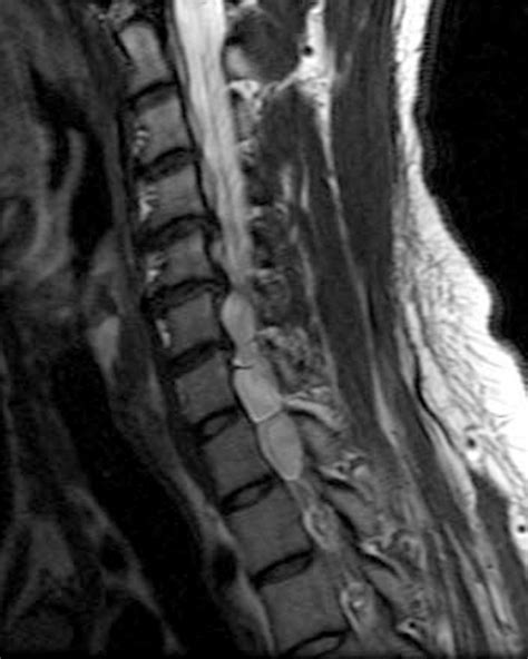 Brachial Plexopathy | Radsource