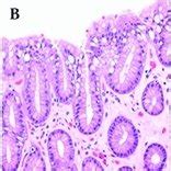 (A) Foveolar hyperplasia (between arrows); in comparison to normal... | Download Scientific Diagram