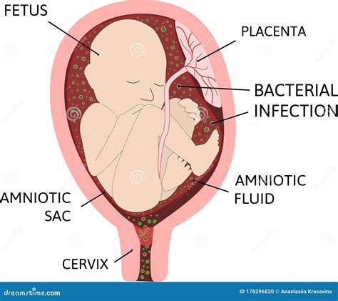 Chorioamnionitis or Intra-amniotic Infection IAI is an Inflammation of ...