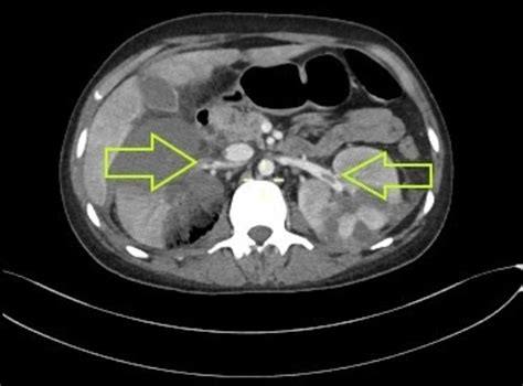 Cureus | A Rare Case of Paroxysmal Nocturnal Hemoglobinuria With ...