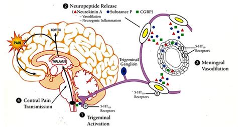 Four stages of a Migraine | Migraine prevention, Migraine, Migraine cause