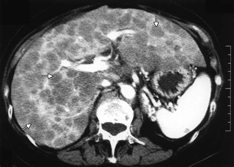 CT and MRI of Cirrhosis and its Mimics | AJR