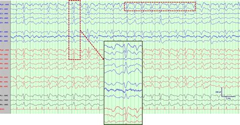 Atypical or Typical Triphasic Waves—Is There a Difference? A... : Journal of Clinical ...