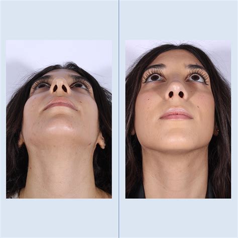 Septoplasty And Turbinate Reduction Before And After