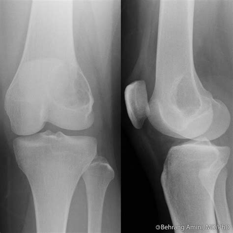 Roentgen Ray Reader: Metaphyseal Lesions