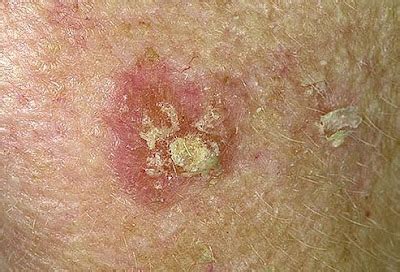 Doctors Gates: Actinic Keratosis & Actinic Cheilitis