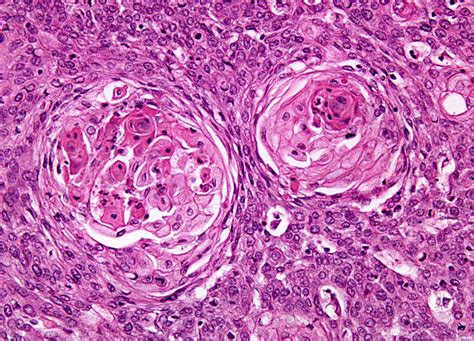 Squamous Cell Carcinoma