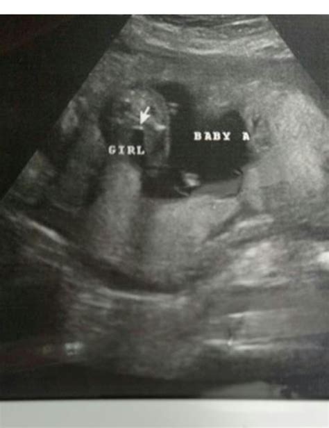 16 week ultrasound. Tech said girl. What do y'all think?!