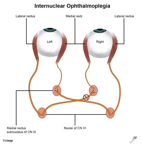 Internuclear Ophthalmoplegia - Ophthalmology - Medbullets Step 2/3