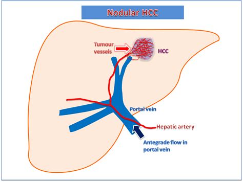 Portal Vein Thrombosis