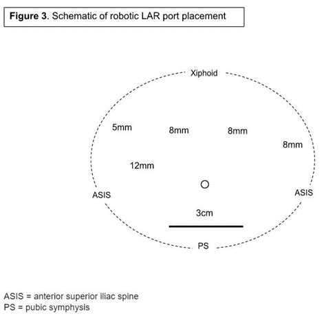 Robotic Low Anterior Resection with Diverting Loop Ileostomy for Locally Advanced Rectal Cancer ...