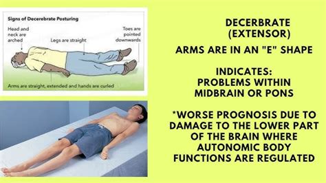 Abnormal Posturing Brain Injury