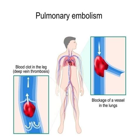 Pulmonary Embolism Pulmonary Embolism Pulmonary Pulmo - vrogue.co