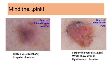 Dermatoscopic features of thin nodular melanoma - Dr. Dimitris Sgouros ...