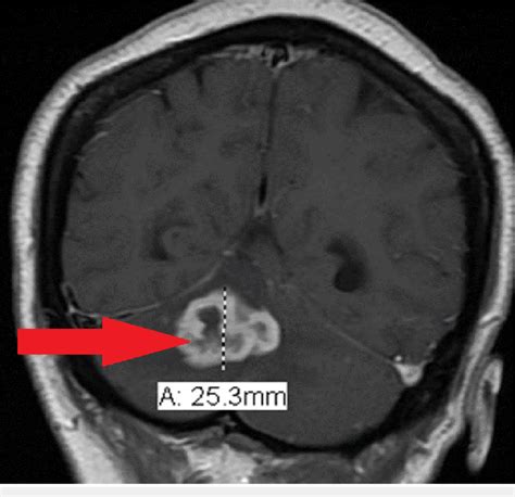 MRI of the brain (coronal view) shows a right cerebellar ring-enhancing... | Download Scientific ...