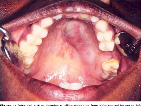 Figure 1 from Adenoid cystic carcinoma of the palate: case report and review of literature ...