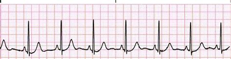 The 6 Steps Method On How To Interpret Electrocardiogram Results EASILY! | RNspeak