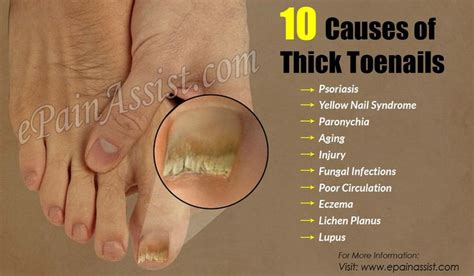 10 Causes of Thick Toenails | Thick toenails, Toe nails, Nail remedies