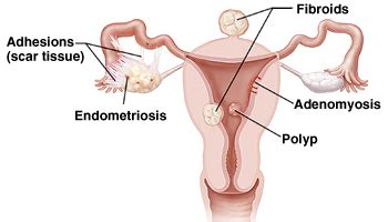 Problems Laparoscopic Hysterectomy Can Treat | Saint Luke's Health System