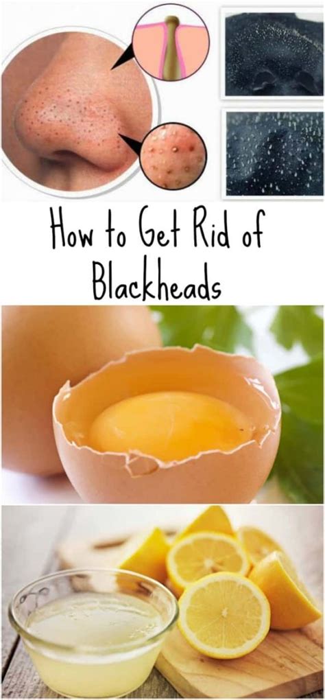 Awesome Homemade Blackheads Removers That Are Easy To Make - ALL FOR FASHION DESIGN