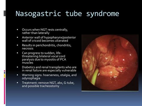 PPT - Laryngeal complications of endotracheal intubation PowerPoint ...