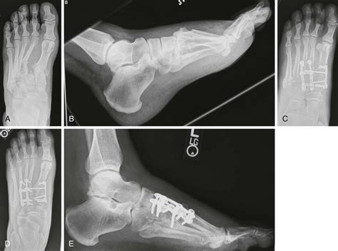 Treatment of Hindfoot and Midfoot Arthritis | Musculoskeletal Key