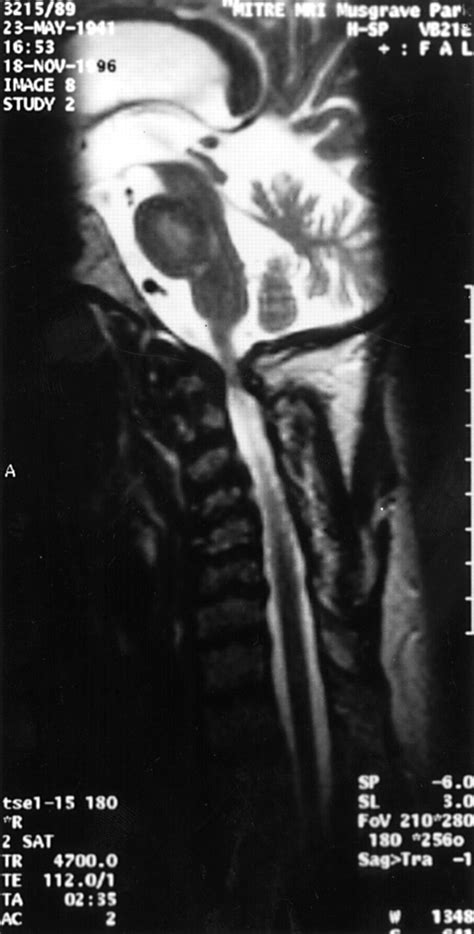 An unusual cause of atlanto-axial subluxation | Annals of the Rheumatic Diseases