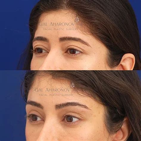 Brow Lift | Plastic Surgery