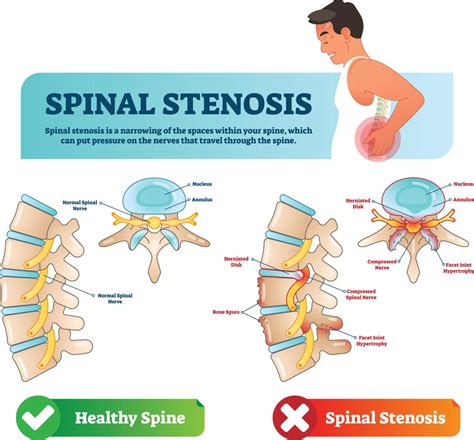 Spinal stenosis could be causing your walking problems | Cairo S Corner ...