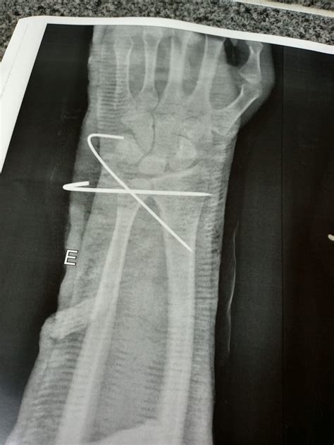 Fracture of the ulnar styloid process with dislocation : r/brokenbones