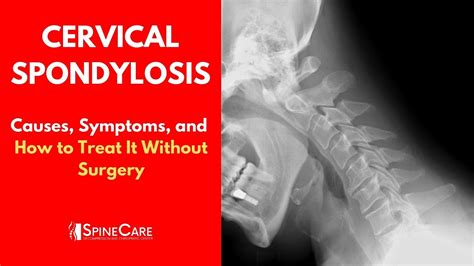 CERVICAL SPONDYLOSIS Causes, Symptoms and Treatment (NO SURGERY) - YouTube