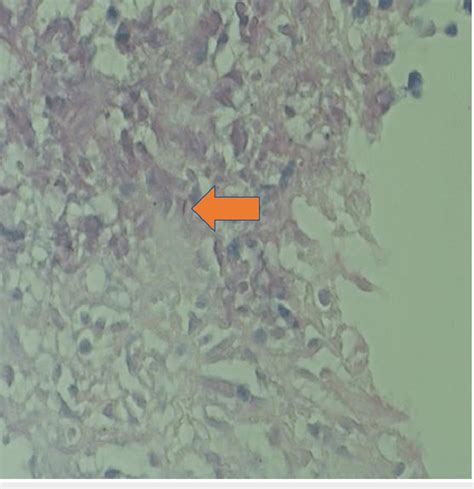 Positive AFB stain on supraclavicular lymph node biopsy (H&E, 40×) H&E:... | Download Scientific ...