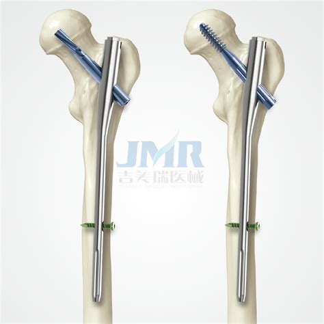 PFNA (Proximal Femoral Nail Antirotation) (401005) - China Pfna and Intramedullary Nail