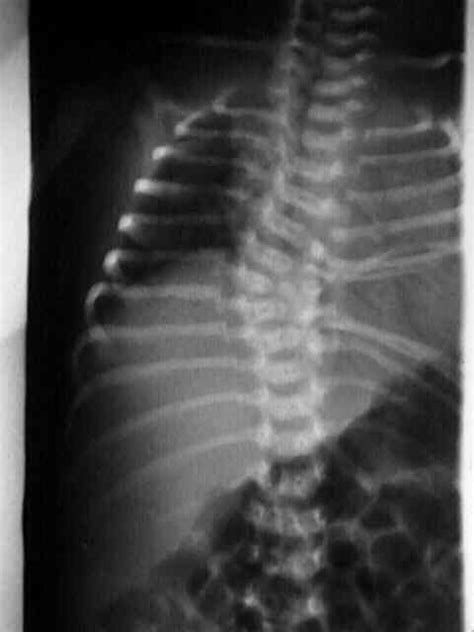 Hemi-vertebrae & Segmented Vertebrae : Wheeless' Textbook of Orthopaedics